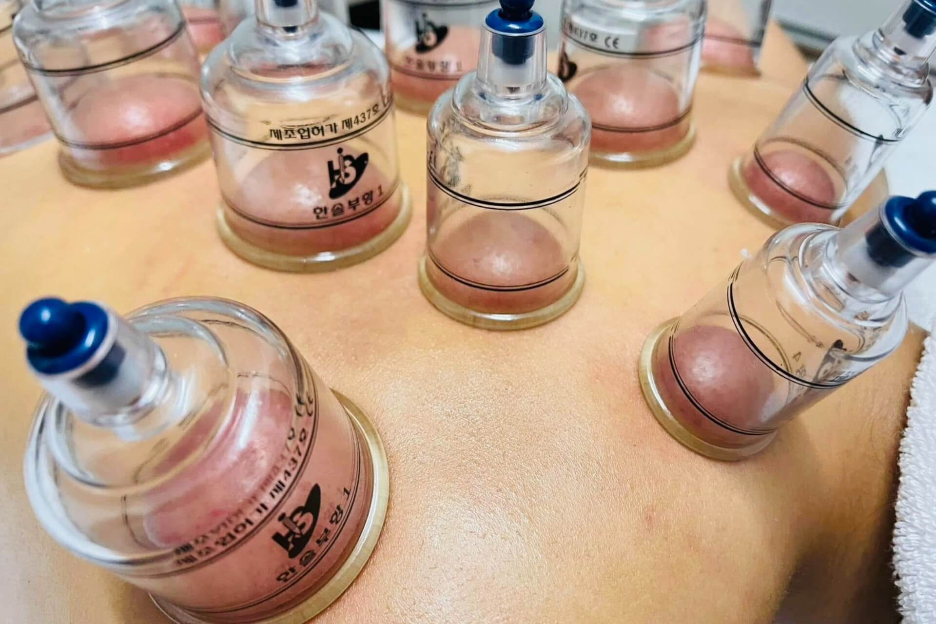 Cupping Massage Therapy