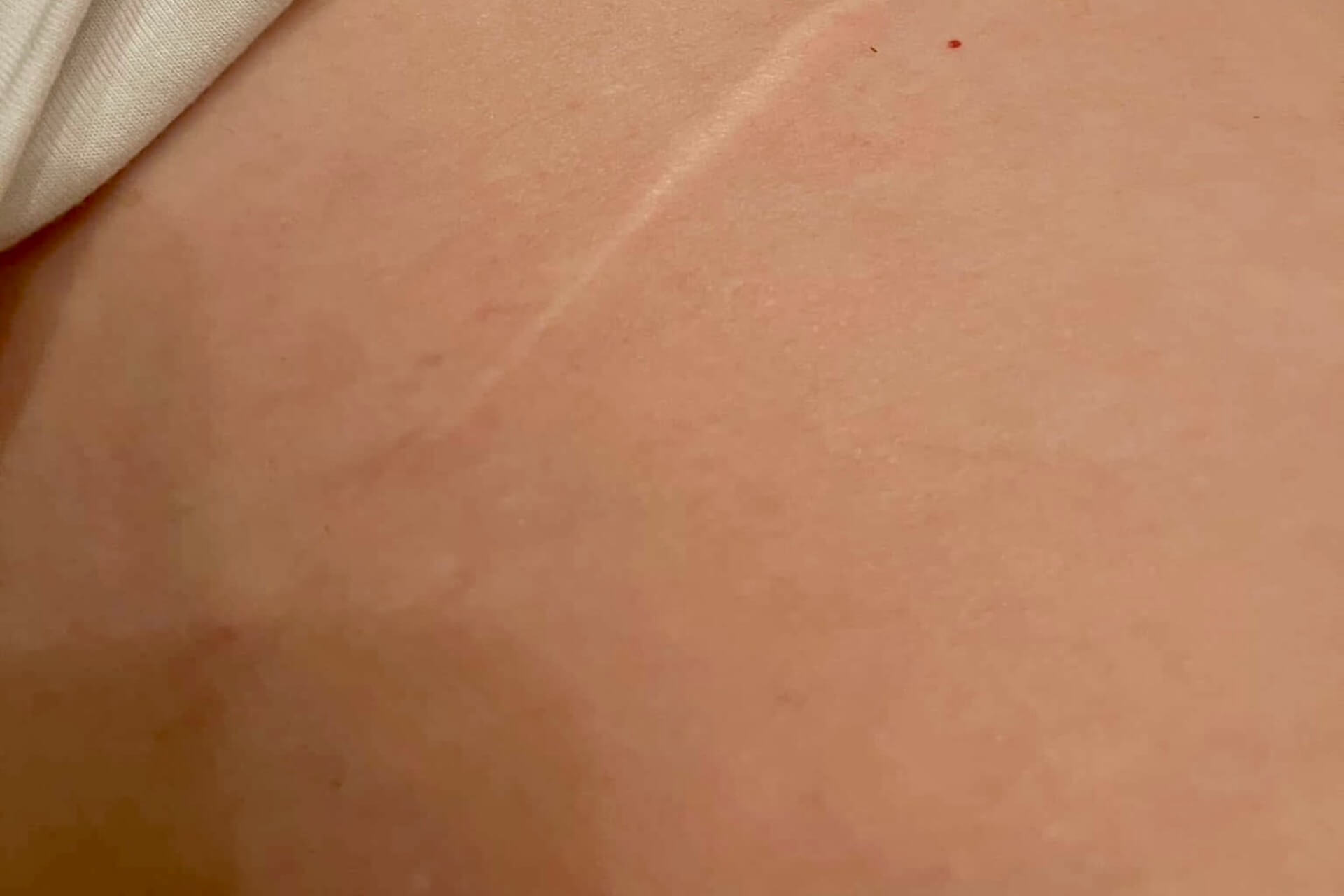 Pre Operative Massage